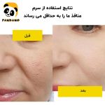 سرم کوچک کننده منافذ باز لانبنا (Lanbena)